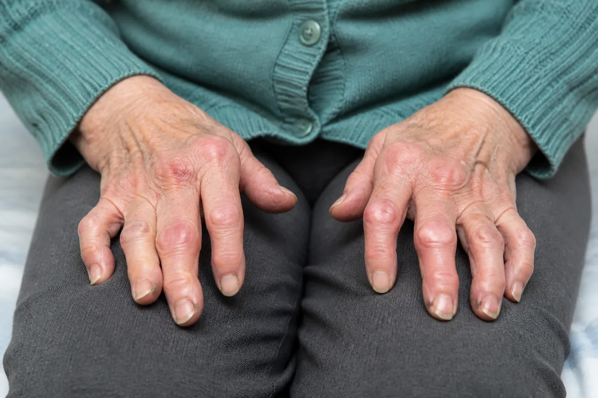 Arthritis