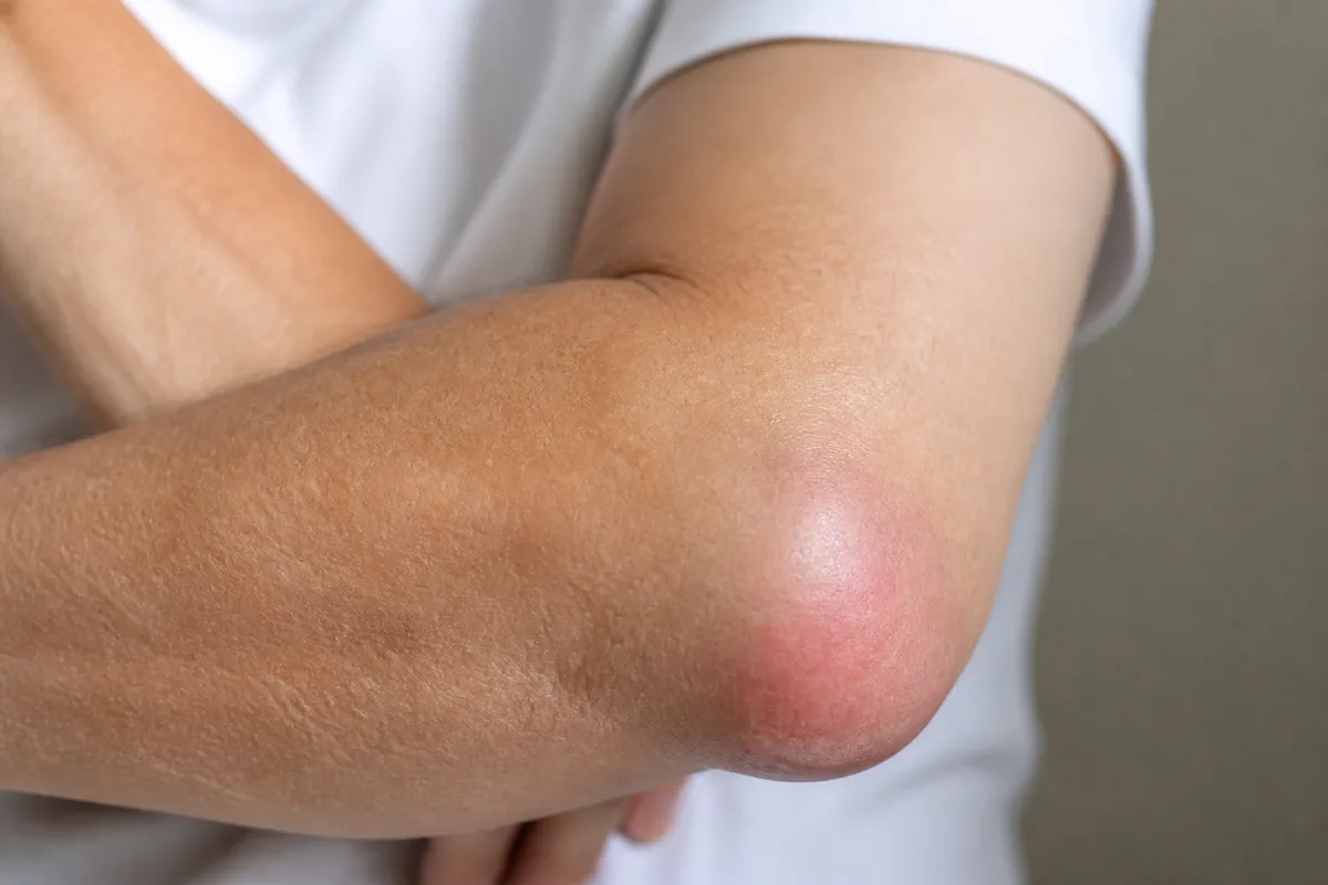 Bursitis